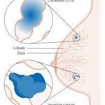 Carcinoma Lobulillar In Situ (LCIS)