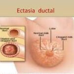 Ectasia Ductal en el Seno