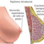 Papilomas Intraductales del Seno