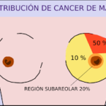 Cáncer de Mama: Síntomas, Tratamiento y Especialistas a Consultar