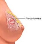 Fibroadenomas