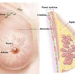 Mastopatía Diabética: Síntomas, Tratamiento y Especialistas a Consultar